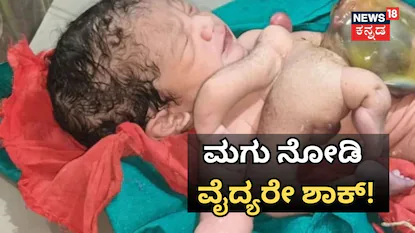 ಮಗು ನೋಡಿ ವೈದ್ಯರೇ ಶಾಕ್​!